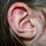 ear eczema