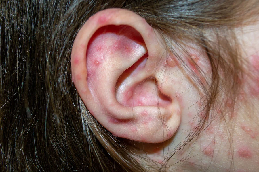 ear eczema