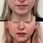 Smooth chin after Botox treatment